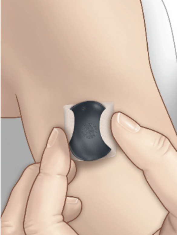 A hand attaches a small, black medical CGM sensor to an upper arm in a clinical setting.